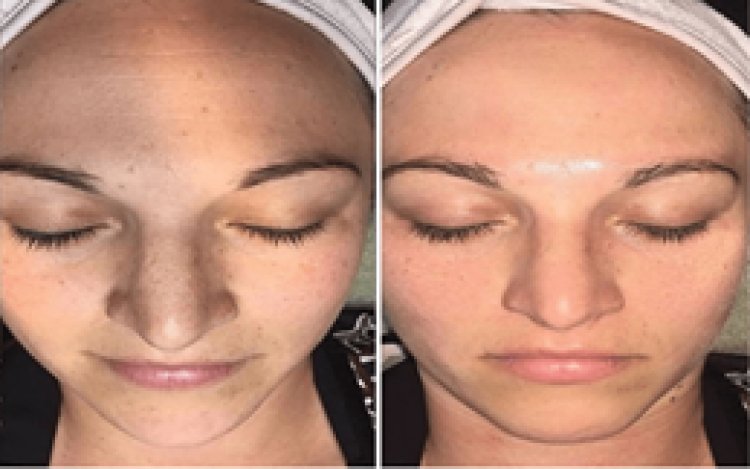 Expert Insights: Why Skin Looks Worse After Hydrafacial