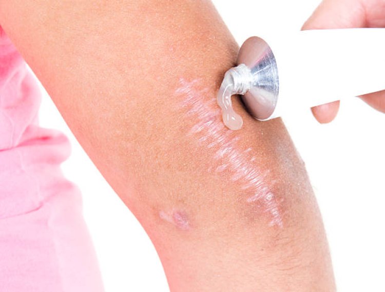 Laser Therapy for Keloid Removal in Abu Dhabi