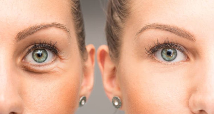 Minimally Invasive Eyelid Surgery in Abu Dhabi