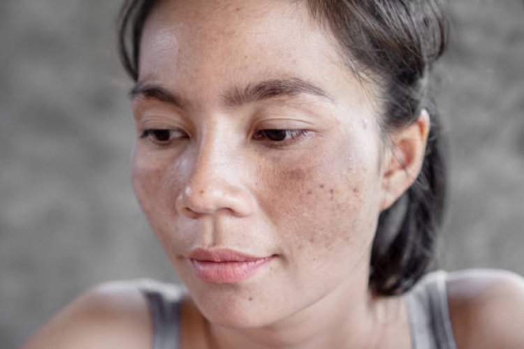 Your Guide to Freckles and Blemishes Removal in Abu Dhabi