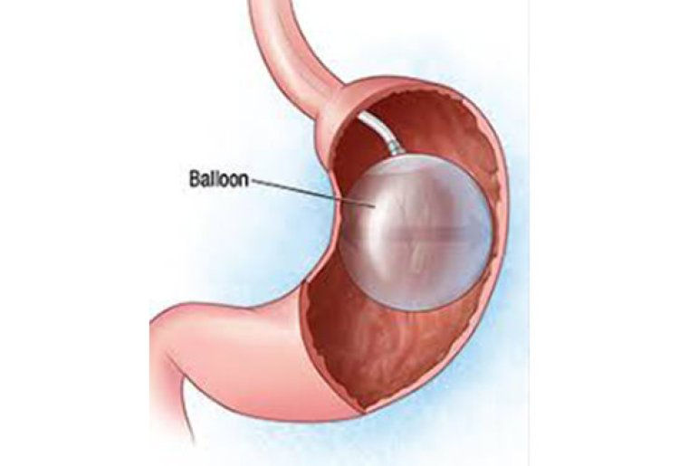 Intragastric Balloon: A Comprehensive Solution for Obesity