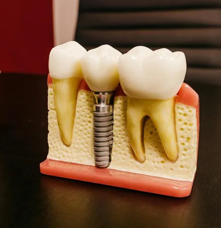 Dental Implants in Hyderabad: The Ultimate Solution for Missing Teeth