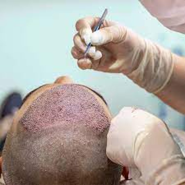 Get Long-Lasting Results with FUE Hair Transplant