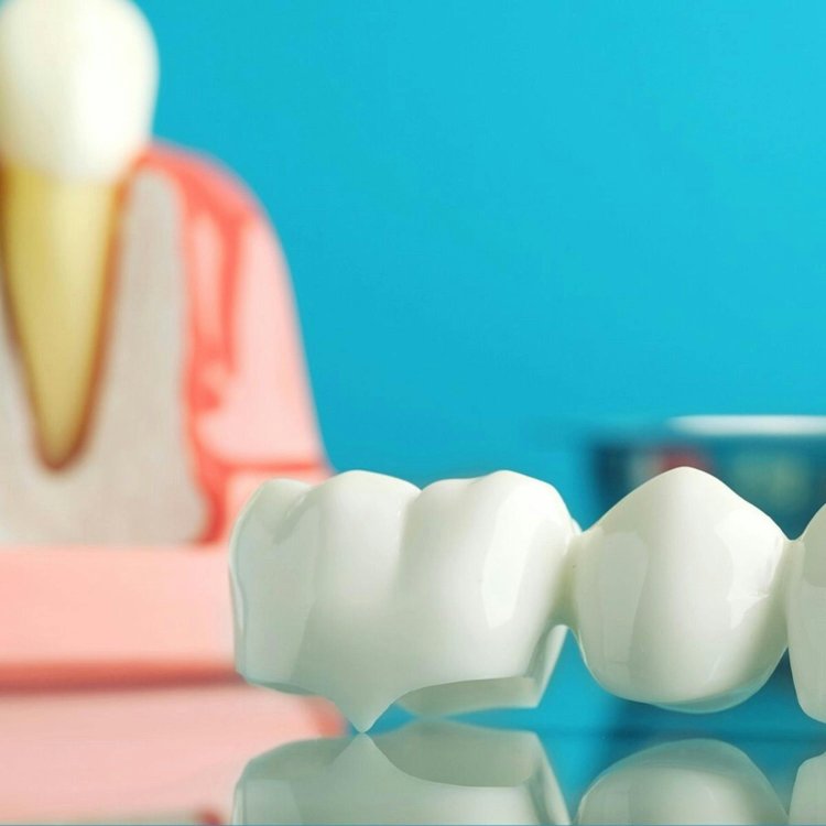 Dental Crown And Bridges Market 2024 : Size, Growth Rate, Business Module, Product Scope, Regional Analysis And Expansions 2033