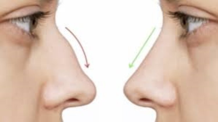 Understanding Rhinoplasty in Dubai: A Step-by-Step Guide