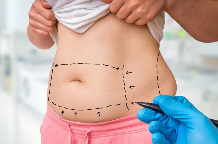 Ultimate Guide to Liposuction Surgery in Dubai