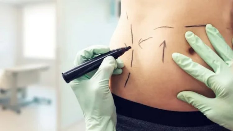 Liposuction as a Confidence Booster: Real Patient Insights