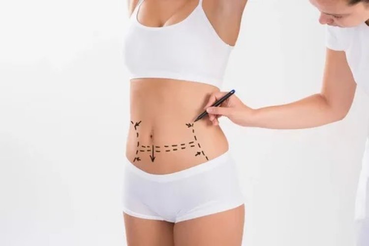 Liposuction Surgery in Riyadh: A Comprehensive Guide