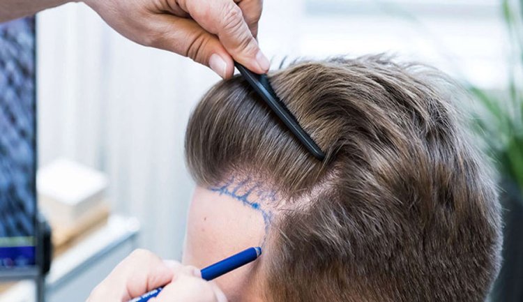 Expert Guide to Hair Transplant Cost in 2024