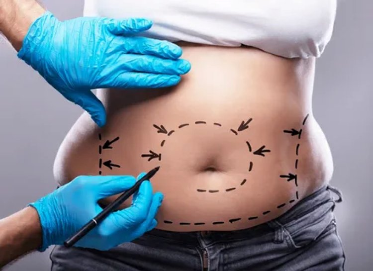 Circumferential Abdominoplasty vs. Traditional Tummy Tuck