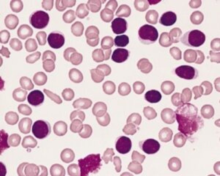 Thalassemia Blood Transfusion Cost in India: A Comprehensive Guide