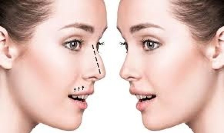 How Long Does a Rhinoplasty in Dubai Take? A Complete Guide