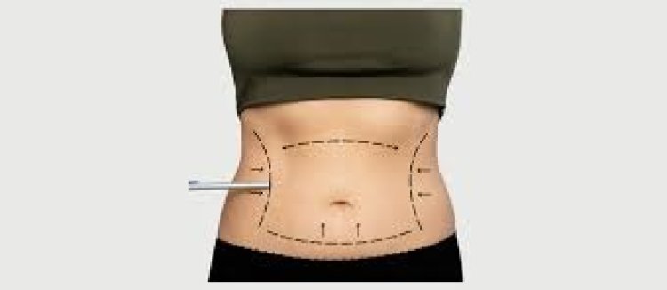 Liposuction in Dubai: Tailored Solutions for a Contoured Look