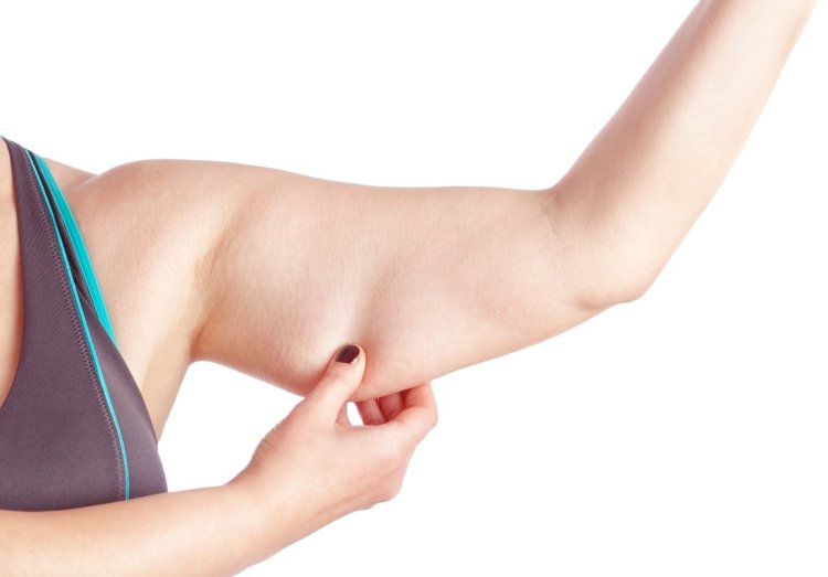 What is Lipedema on the Upper Arms? Causes, Symptoms, and Treatment