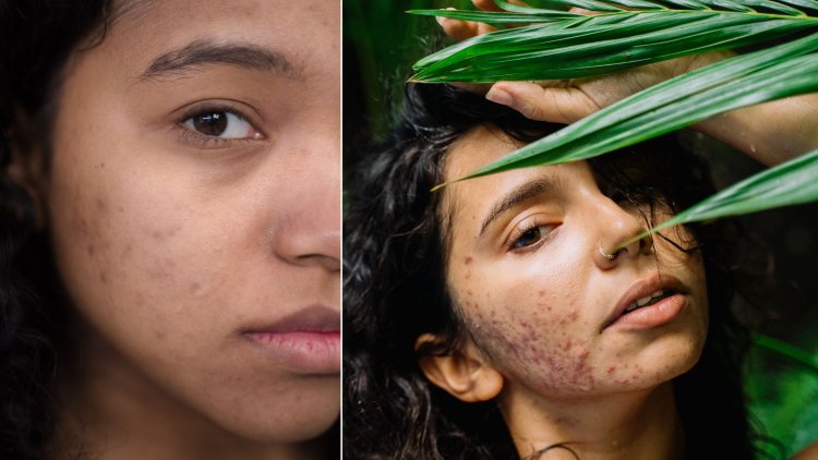 The Connection Between Hormones and Acne: What Women Should Know