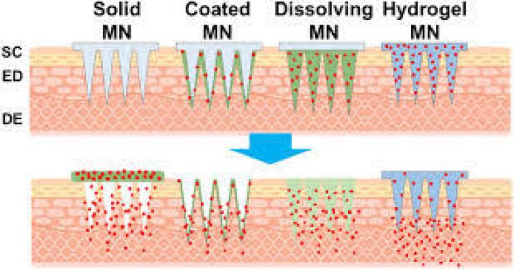 Global  Microneedle Drug Delivery System Market Size, In-Depth Assessment, CAGR, Demand, and Opportunity Analysis 2030 with Top Countries Data