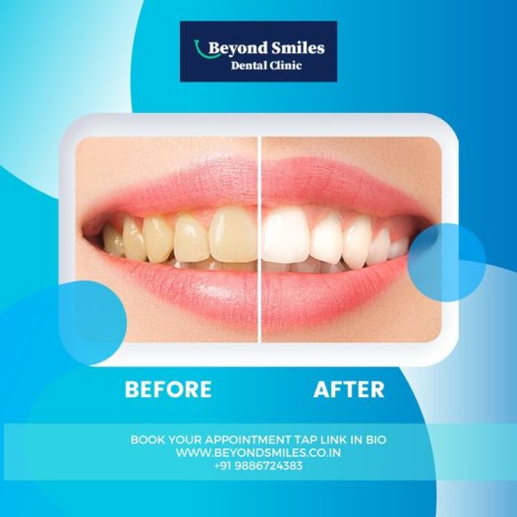 Teeth Cleaning Dental Clinic Indiranagar