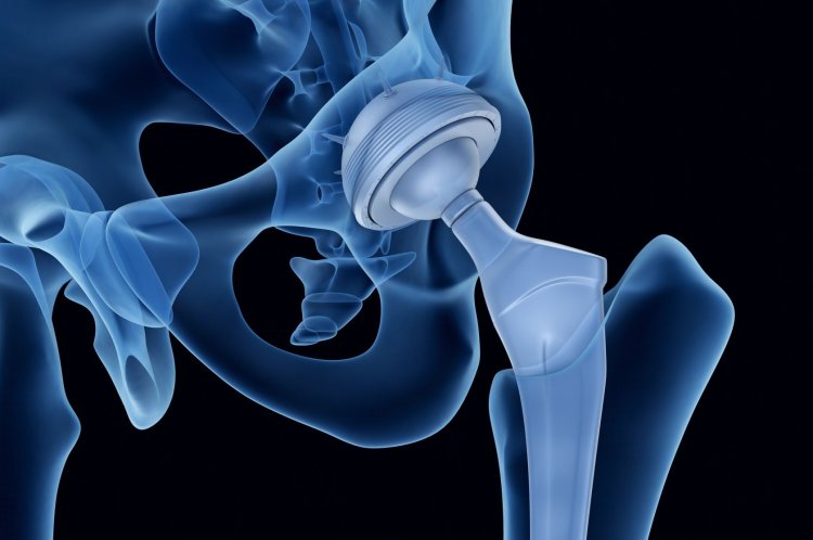 How to Choose the Best Hip Replacement Surgeon in Lahore?