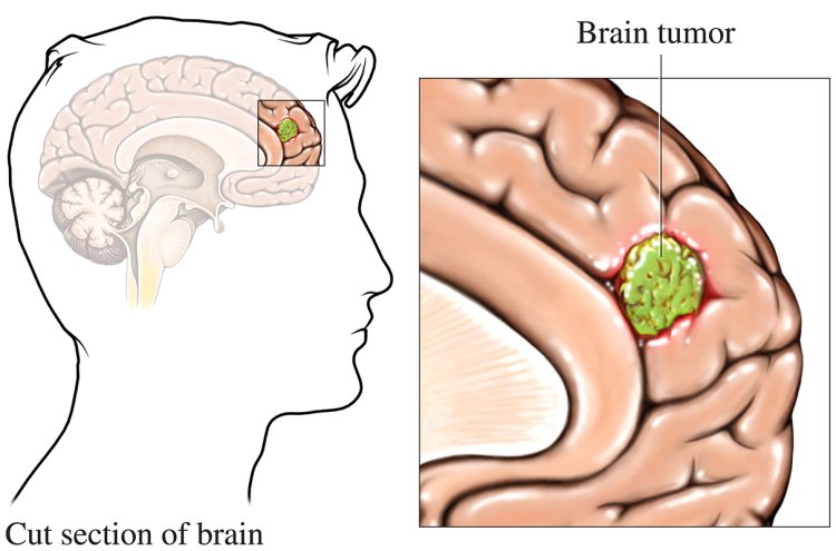 Is Brain Tumor Deadly? Understanding Risks, Prognosis, and Treatment Options