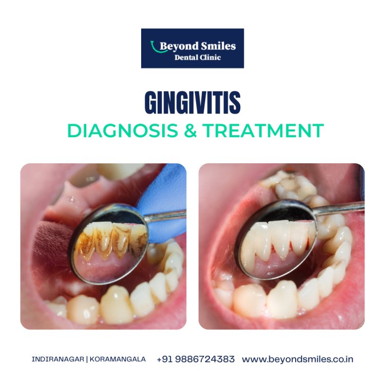 Periodontal disease treatment in Kanakapura