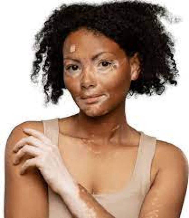 Shades of Beauty: Transforming Vitiligo with Advanced Care