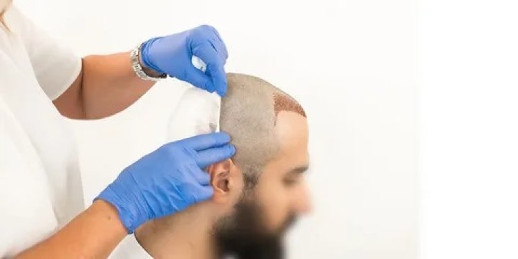 The Future of Hair Restoration: Innovations in Dubai