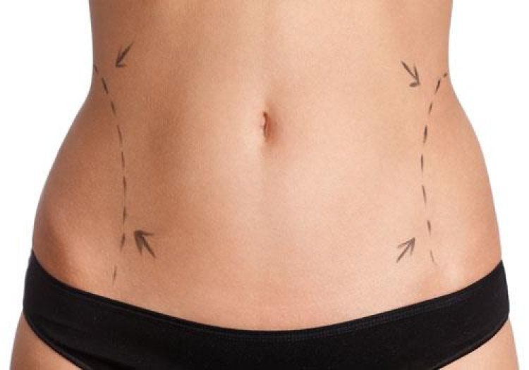 What Makes Liposuction in Dubai So Popular?