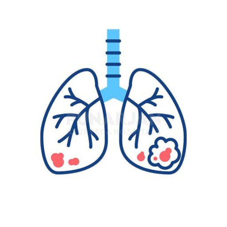 Best Lung Cancer Treatment Hospitals in Bangalore