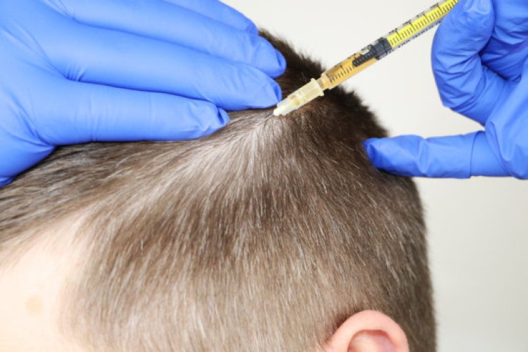 PRP for Male Pattern Baldness in Dubai: A Natural Hair Regrowth Treatment