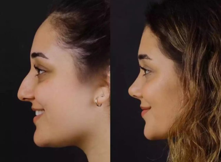 What to Know Before Visiting the Best Septoplasty Surgeons in Dubai?