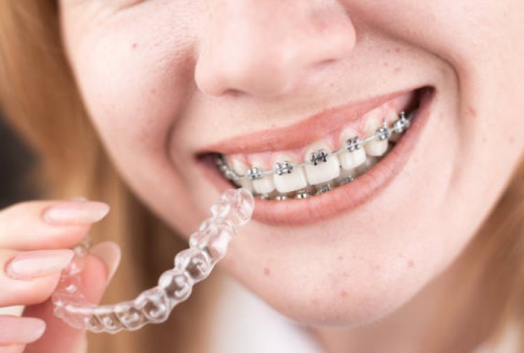 What are clear aligners, and how do they work to straighten teeth?