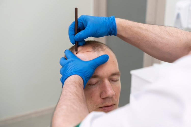 Hair Transplantation Aftercare: Expert Advice for You