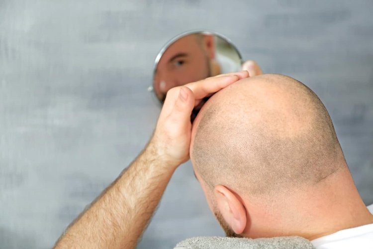 Hair Transplantation: Real Patient Budgets