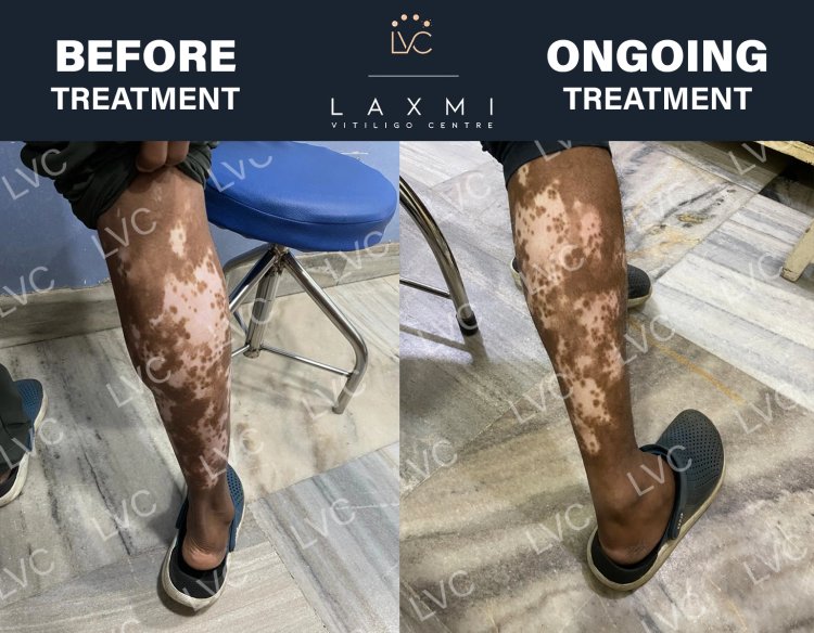 Best Doctor & Best Homeopathic Vitiligo Treatment and Packs.