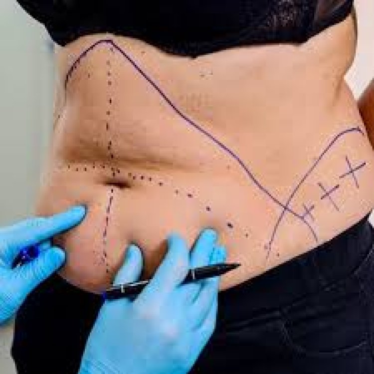 Feel Confident Again with Liposuction Surgery in Riyadh 