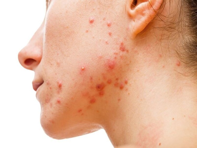 Topical Androgen Receptor Inhibitors Market Size, Industry, Trends 2025-2033 | Reports and Insights