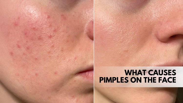 What causes pimples on the face?