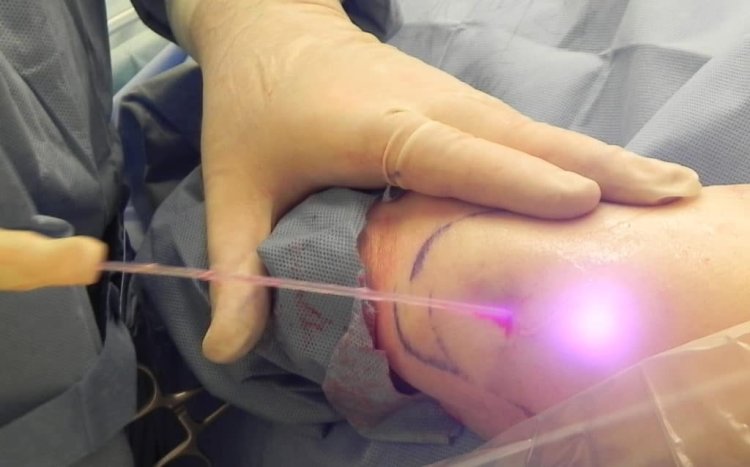 Effective Fat Removal and Potential Skin Tightening with Laser Liposuction