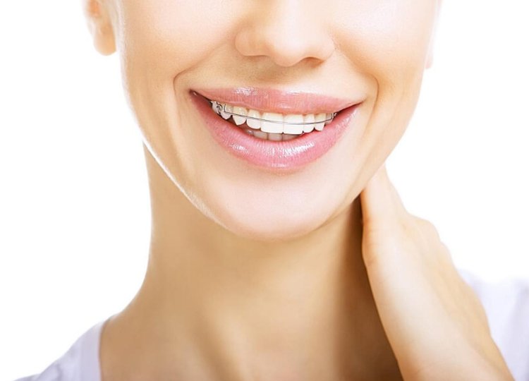Achieving a Fuller Smile: The Aesthetic Benefits of Damon Braces
