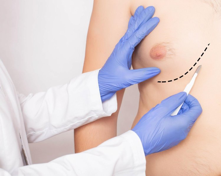 What Age Is Ideal for Gynecomastia Surgery?