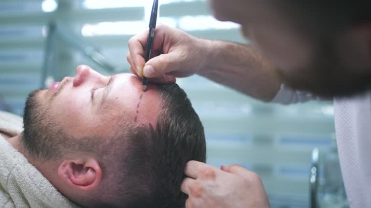 Your First Hair Transplant Consultation in Dubai