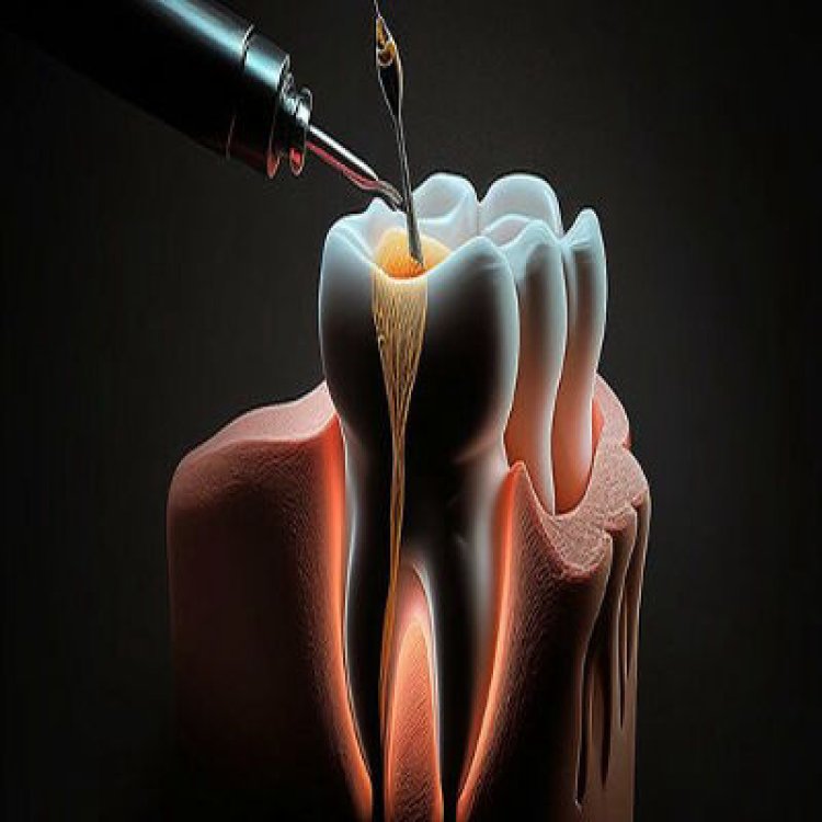 How to Prevent Complications After Root Canal Treatment in Islamabad