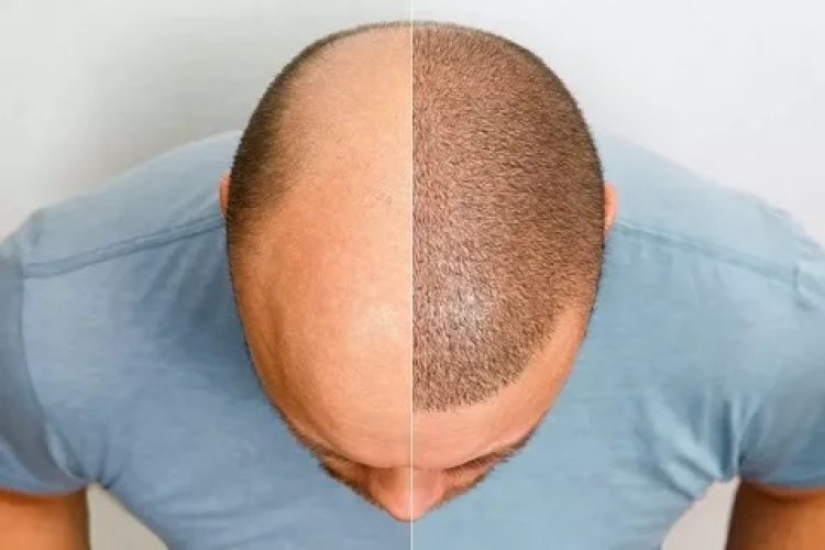 Low-Cost Hair Transplants: How to Avoid Getting Scammed