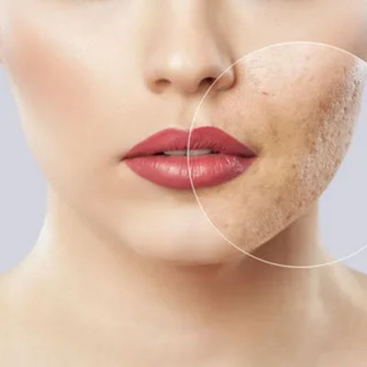 How to Prevent Acne Scars from Developing in Islamabad