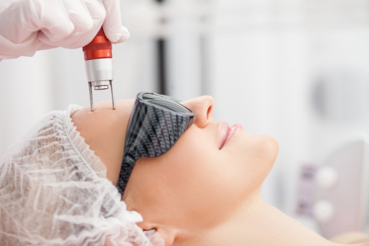 Fractional Laser for Wrinkles: A Beginner’s Roadmap