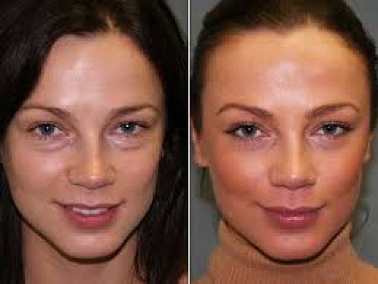 Reclaiming Smoothness: The Vampire Facelift for Acne Scars and Uneven Skin Tone