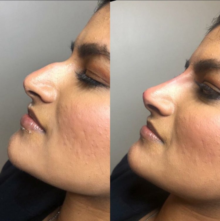 Dubai Nose Job: What to Expect Before, During, and After Surgery