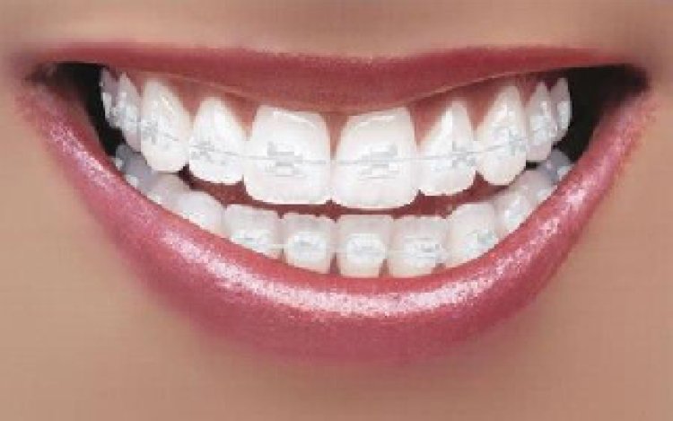 Straightening Teeth, Discreetly: Ceramic Braces Solutions in UAE