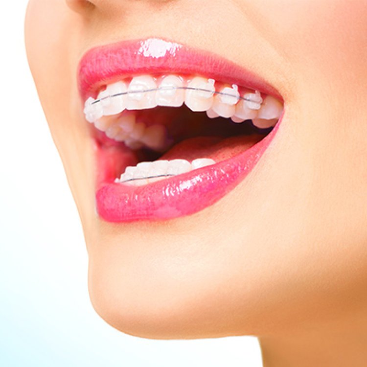 Straightening Teeth Effectively: Metal Braces Solutions in UAE