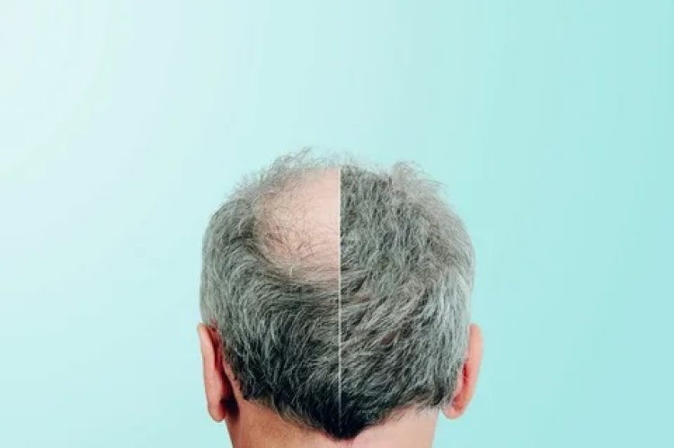 Scalp Micropigmentation vs. Hair Transplant: Which Is Better for You in Dubai?